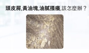 脂漏性皮膚炎症狀有哪些？頭皮屑、黃油塊、油膩、搔癢，遇到該怎麼辦？